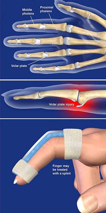 volar plate protocol.